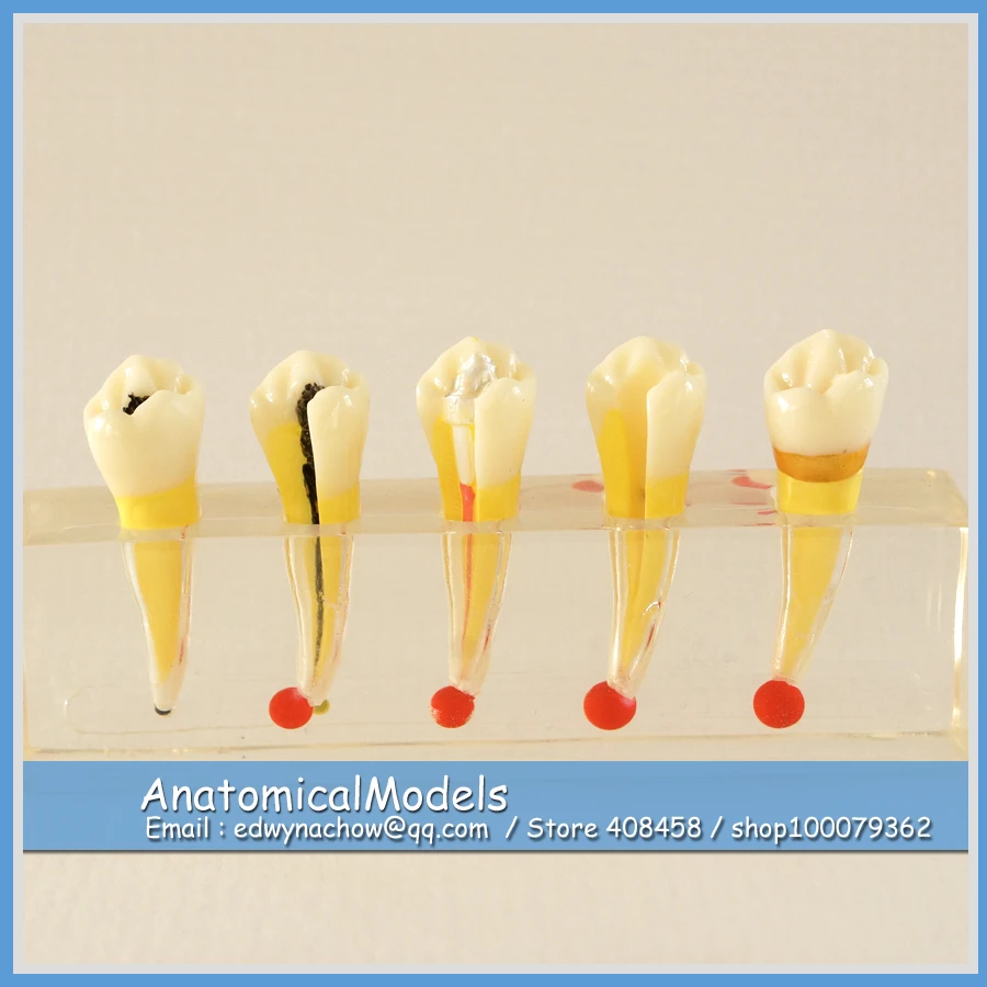 

13151 DH1305 Transparent Dental Pulp Disease Clinical Communication Model , Medical Science Educational Dental Teaching Models
