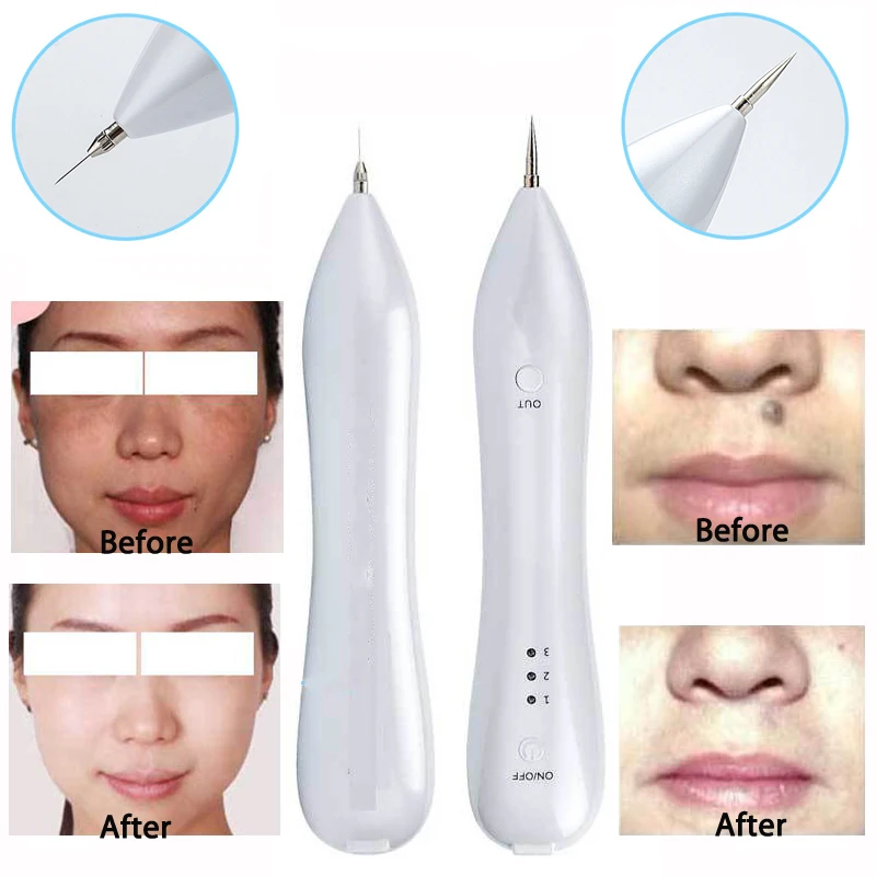 

Mole Removal Pen Portable USB Charging Freckles Dark Spot Nevus Tattoo Dot Mole Remover Machine Perfect for Removing Skin Tag