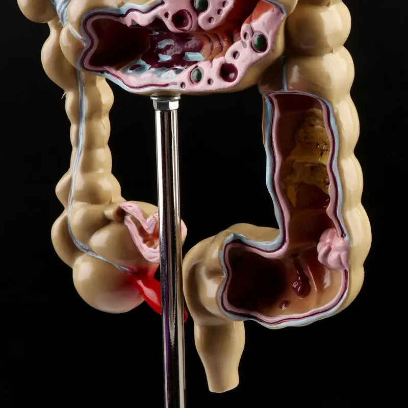 Человека, модель поражения патологическая анатомия Колон заболеваний кишки для медицинской учебной обучающий инструмент