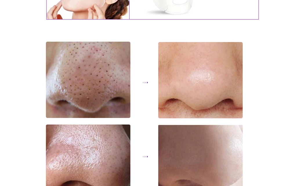 black head removal moisturising machine (7)