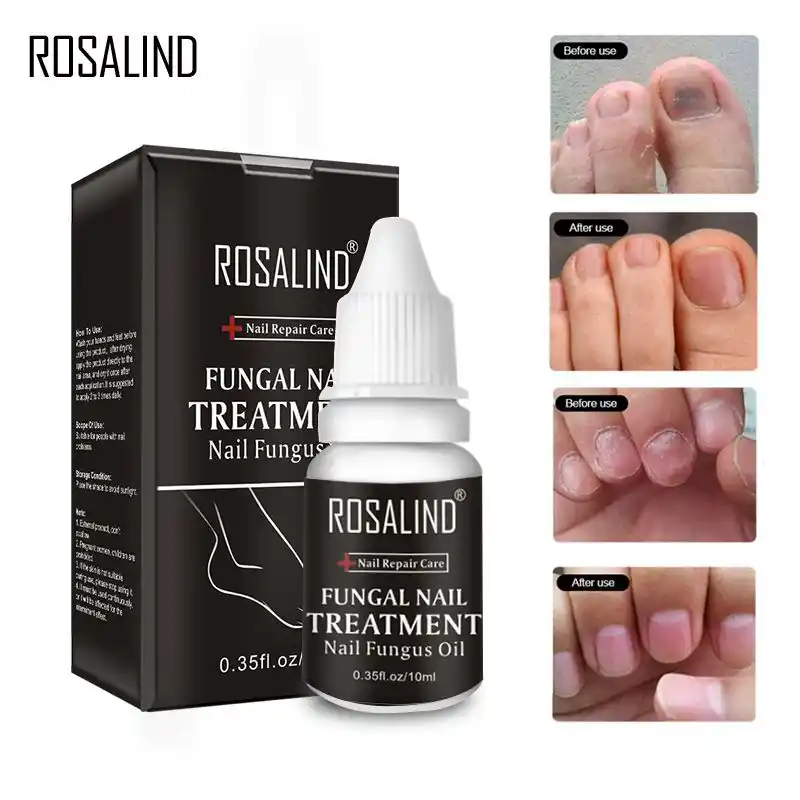 medicina para los hongos de las uñas de los pies medicina para los hongos de las uñas de los pies