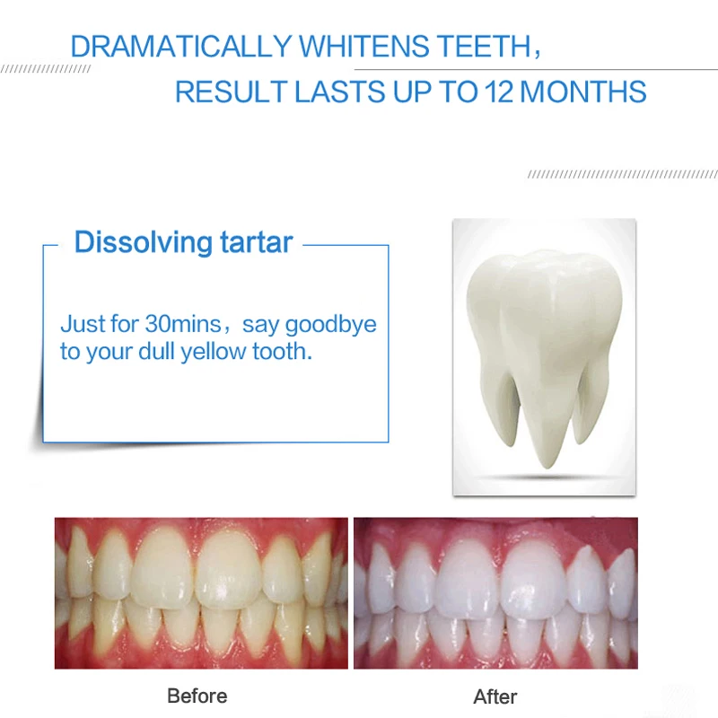 tooth whitening kit (7)