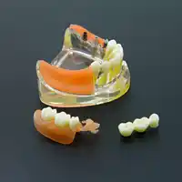 Dental Implant Restoration Teeth Model Removable Bridge Denture Demo #6006