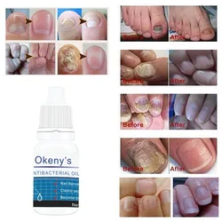 Good Result Nail Treatment Pen Onychomycosis Paronychia Anti Fungal Nail Infection Chinese Herbal Toe Nail Fungus Treatment Good Result Nail Treatment Pen Onychomycosis Paronychia Anti Fungal Nail Infection Chinese Herbal Toe Nail Fungus Treatment