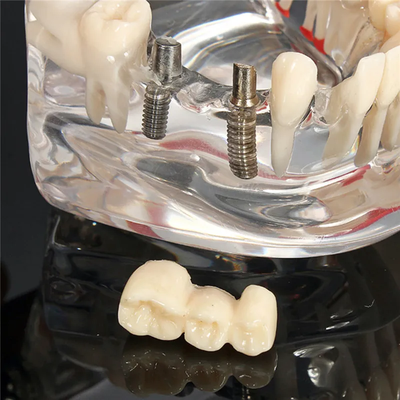 Implant Model zębów dentystycznych z przywracaniem mostek dentystyczny dla nauk medycznych narzędzie do nauki chorób stomatologicznych 4 Implant Model zębów dentystycznych z przywracaniem mostek dentystyczny dla nauk medycznych narzędzie do nauki chorób stomatologicznych 4