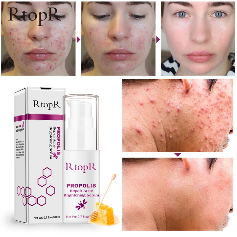 

RtopR Propolis Acne Treatment Serum Repair Acne Brightening Shrink Pore Eliminates Acne Scar Spot Essence Oil control Serum 20ml