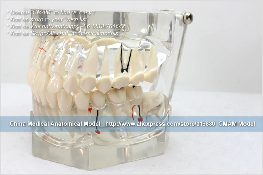 CMAM/12594 Dental-патологическая Стоматологическая модель, 2X в натуральную величину, полости рта человека стоматологический медицинский анатомическая модель