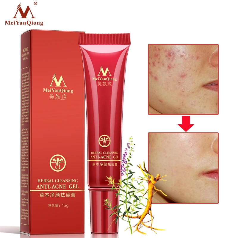 Meiyanqiong бренд Уход за кожей лица Acne Уход за кожей продуктов травяные Очищение анти-акне гель 15 мл лечение акне Уход за кожей лица крем