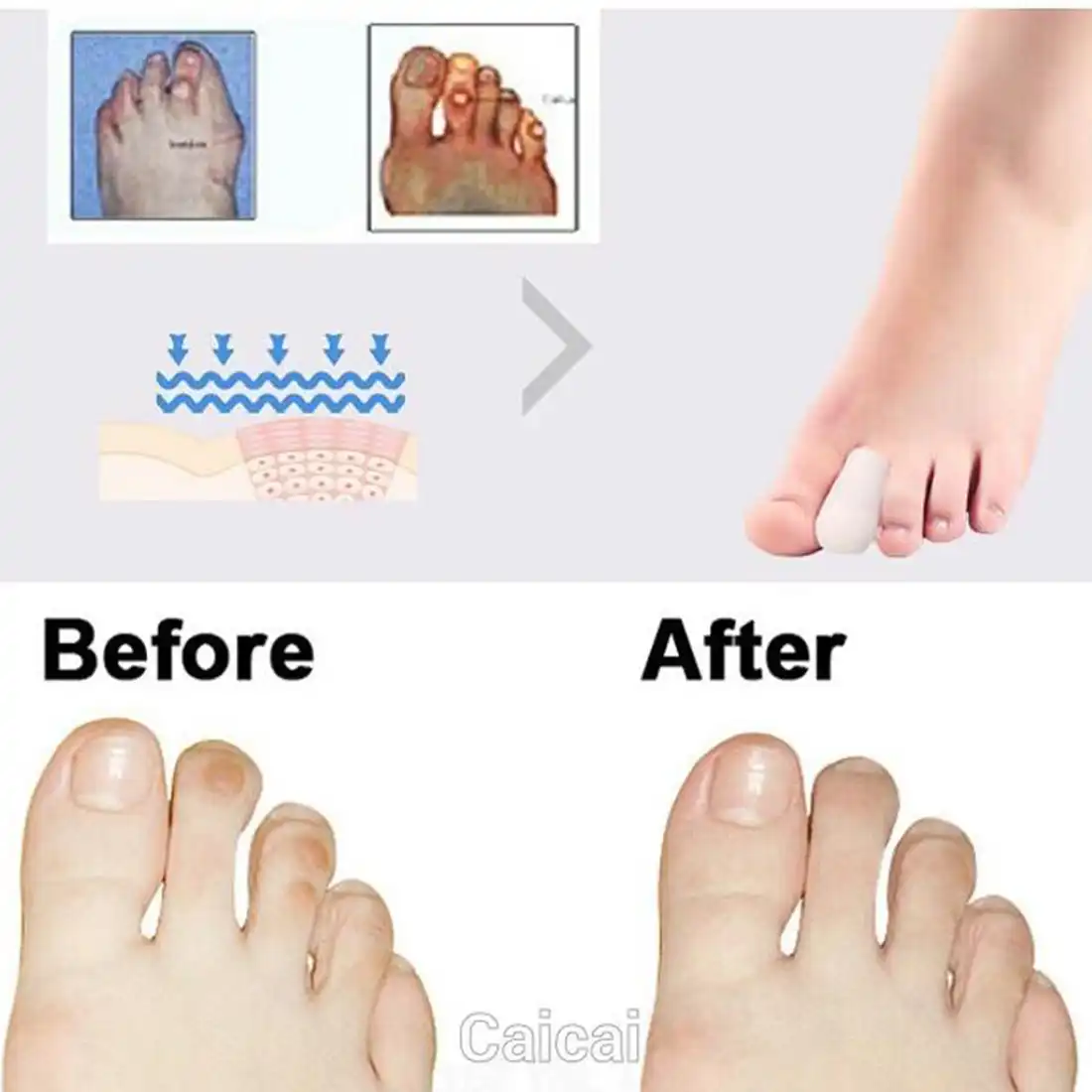 foot corns and bunions
