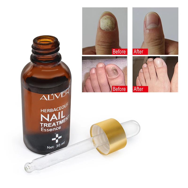 ALIVER травянистое Лечение ногтей эссенция естественное анти-грибковое Лечение ногтей