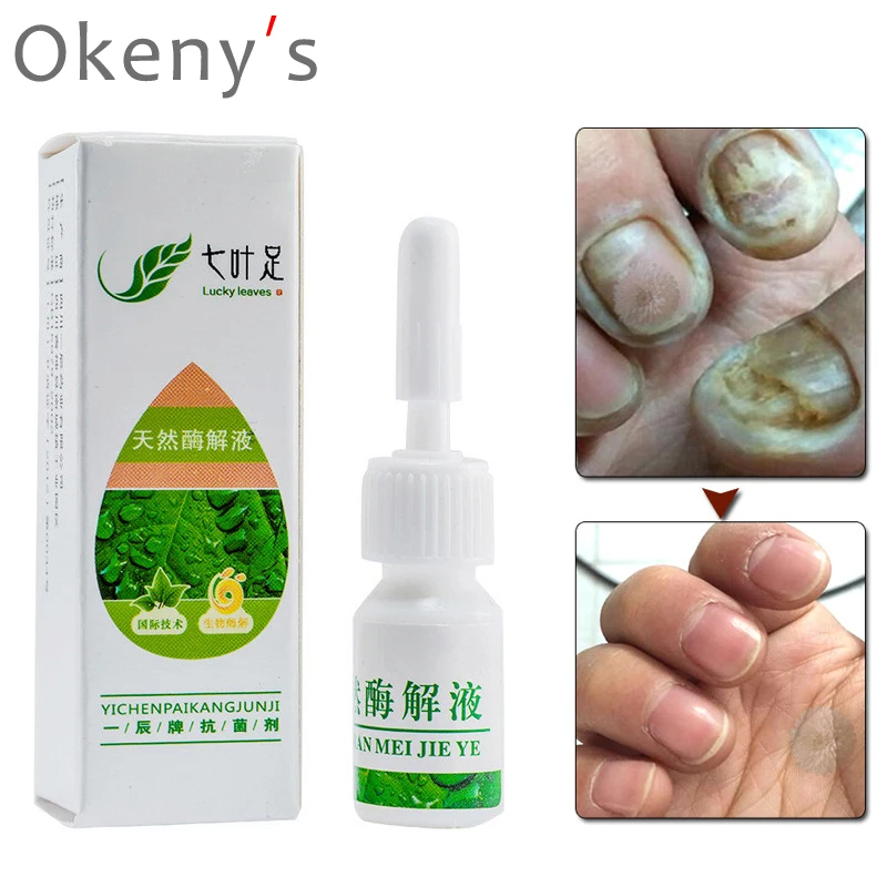 

Toe Nail Fungus Removal Oil Fungal Nail Treatment Feet Care Essence Nail Foot Whitening Anti Infection Paronychia Onychomycosis