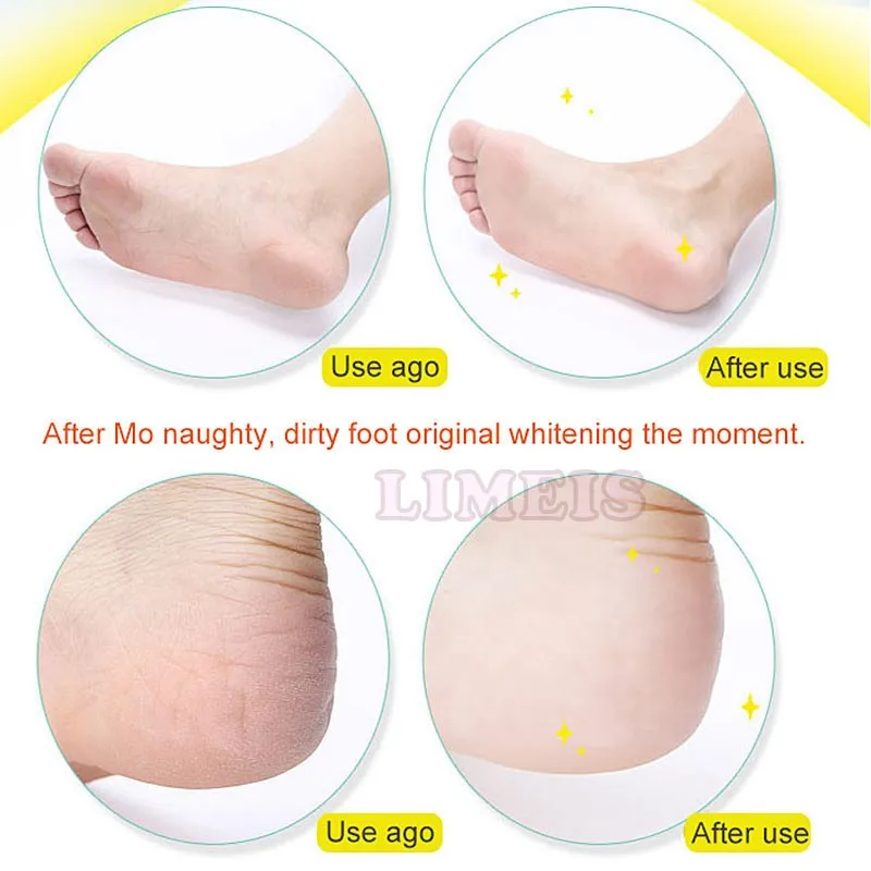 foot callous remover dead dry skin scrapper 5