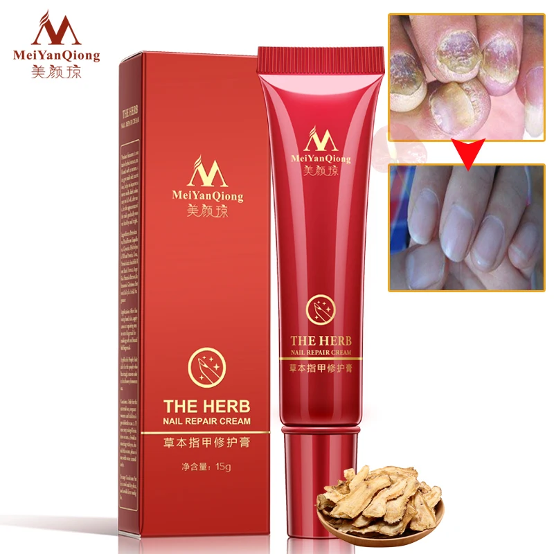 MeiYanQiong Nail Care Herbal Nail Repair Cream Anti Fungal Nail treatment Chinese Herbal Toe Nail Fungus Treatment TSLM2