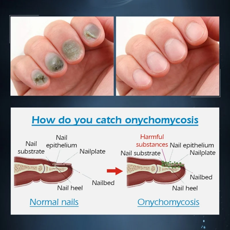 Мощное Лечение грибка для ногтей Onychomycosis удаление крема для ремонта ногтей противогрибковый крем для ремонта ногтей 20 г