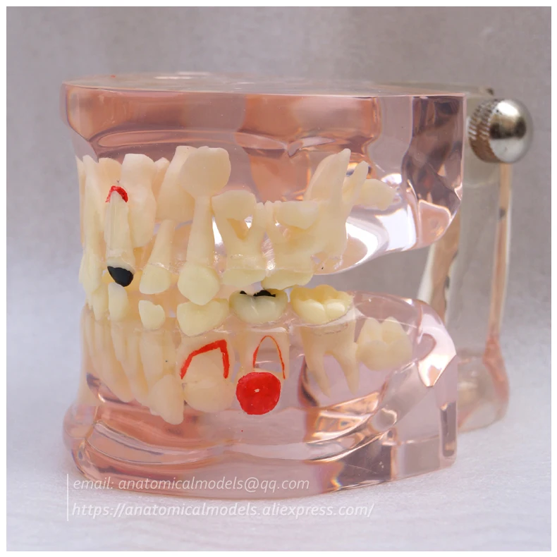 13062 Clear Mixed Age model with Caries 1 