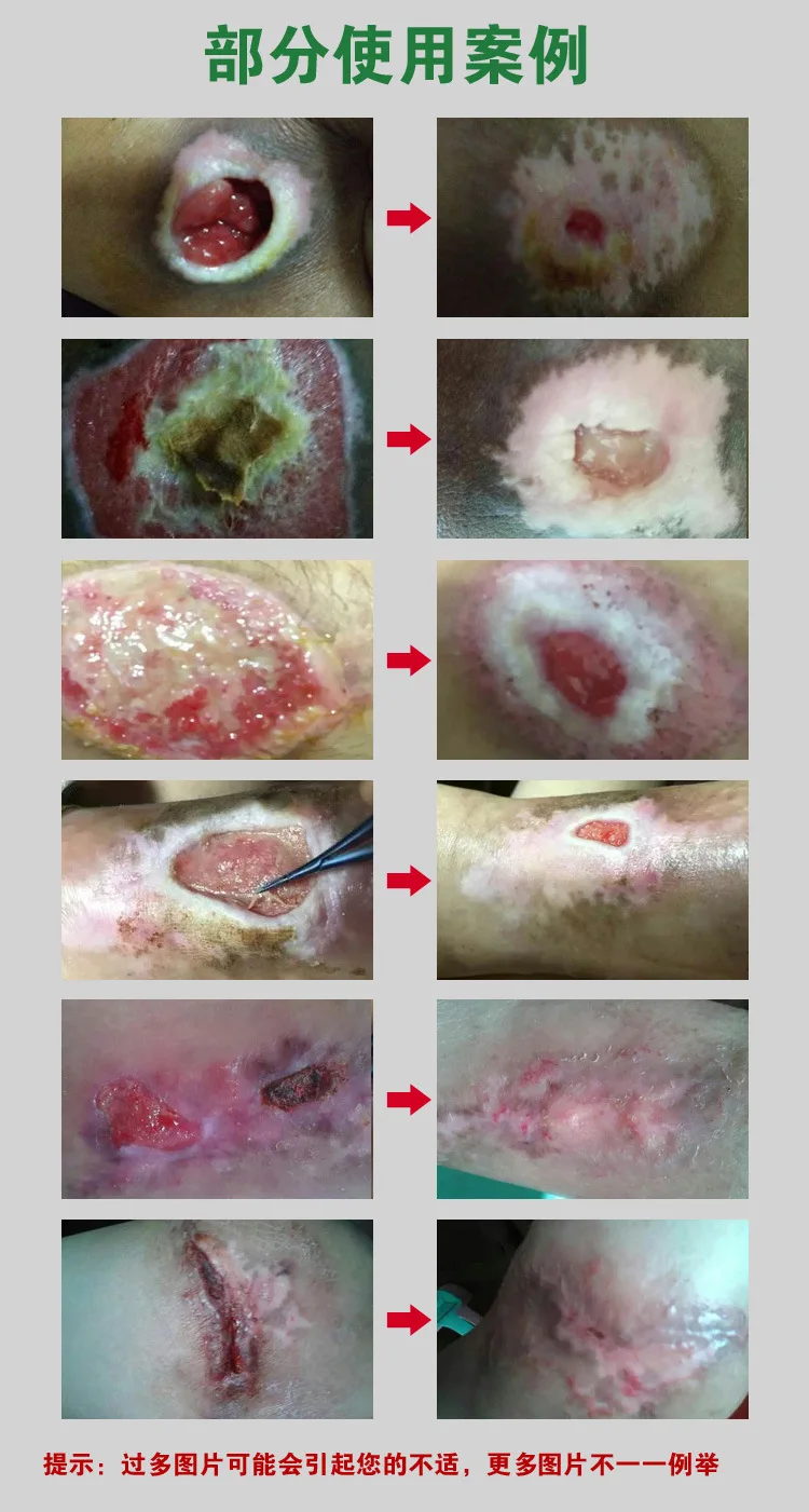Китайская травяная медицина, удаление гноя, миогенический крем, пролежни, паста, лечение давления, язвы, язвенная язва, заживление ран