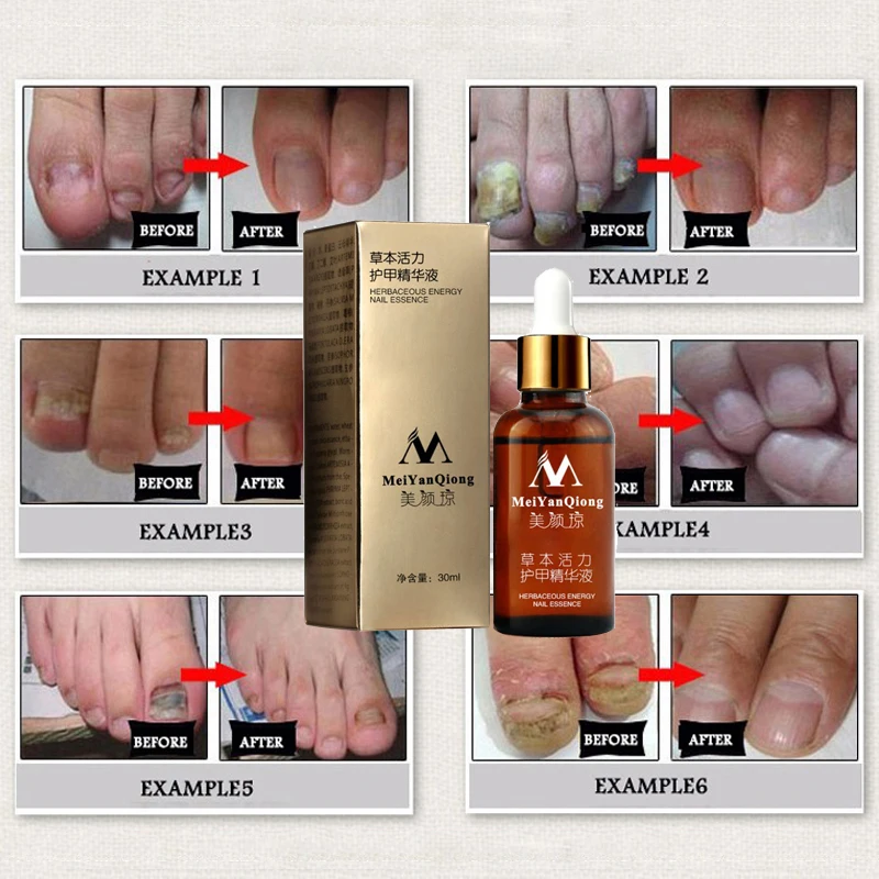 Fungal Nail Treatment Feet Care Essence Nail Foot Whitening Toe Nail Fungus Removal Gel Anti Infection Paronychia Onychomycosis