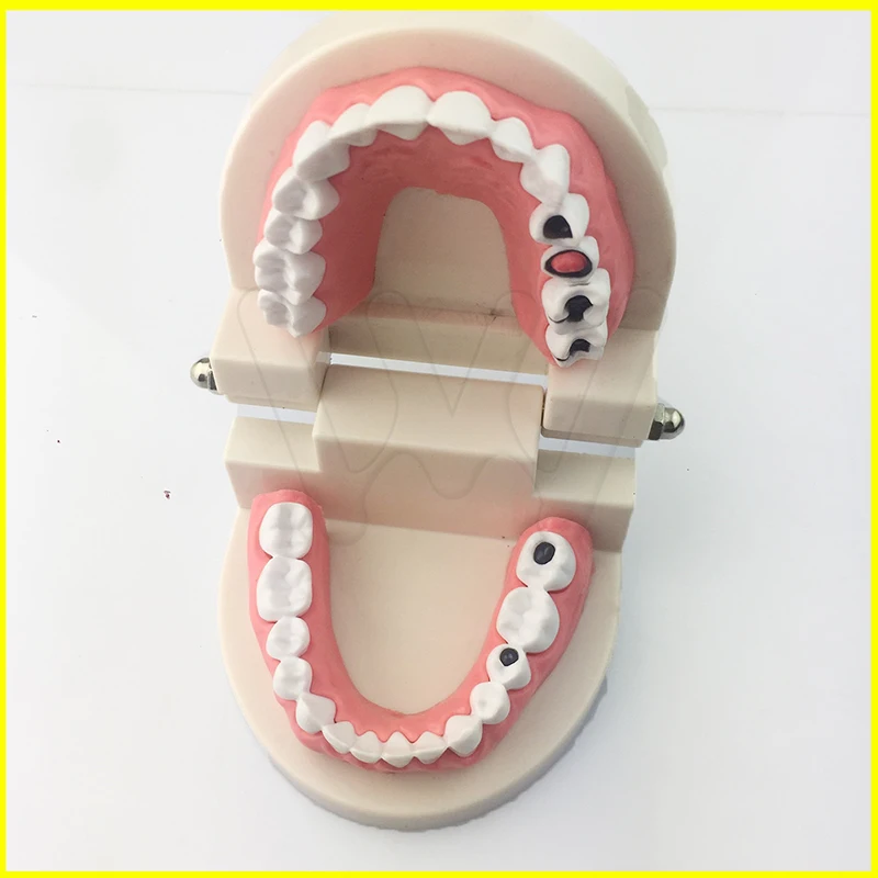 1x-EASYINSMILE-Dental-Caries-Tooth-Study-Model-Typodont