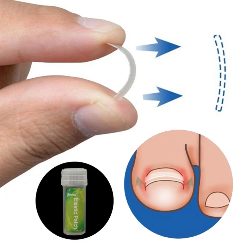 Инструмент для коррекции вросших пальцев ног, выпрямляющий пластырь для ухода за ногами
