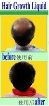 FOR MAN Andrea same formula Hair Growth anti Hair Loss Liquid ml dense hair fast sunburst hair growth invalid refund alopecia