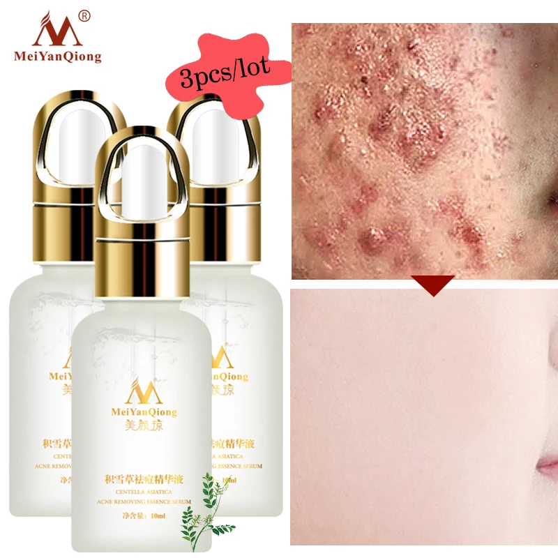 

3pcs/lot Centella Asiatica Acne Extract Removes acne, Eliminates Acne marks, Controls oils, And Whitens Skin 10ml