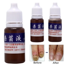 Анти-инфекция Paronychia Onychomycosis Лечение ногтей от грибка жидкая Уход за ногами отбеливающая эссенция носок удаление грибка гель