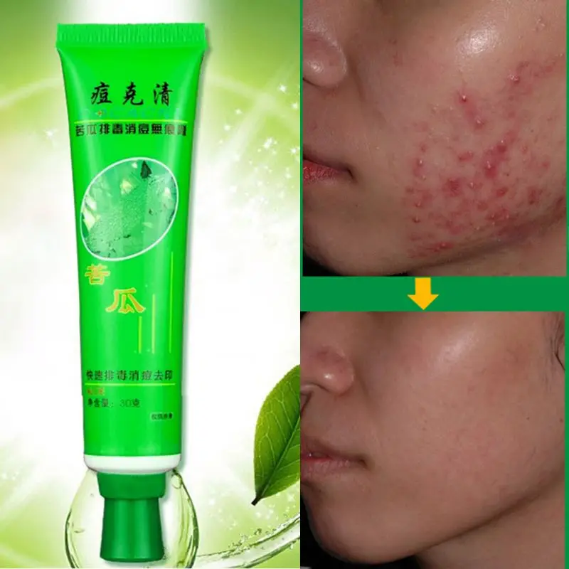 30g Face Skin Care Acne Cream Blain Desalt Blain Imprint Face Cream-in