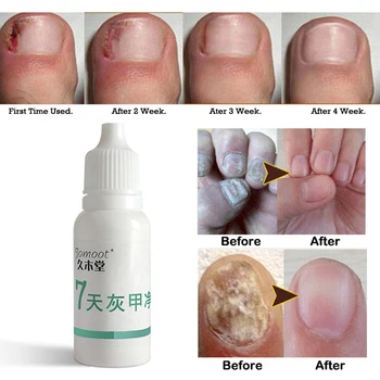 

1pc/Nail Problems Treatment Onychomycosis Repair Gentle And Effective Treatment Onychomycosis Serum Nail Regeneration Gel 10ml