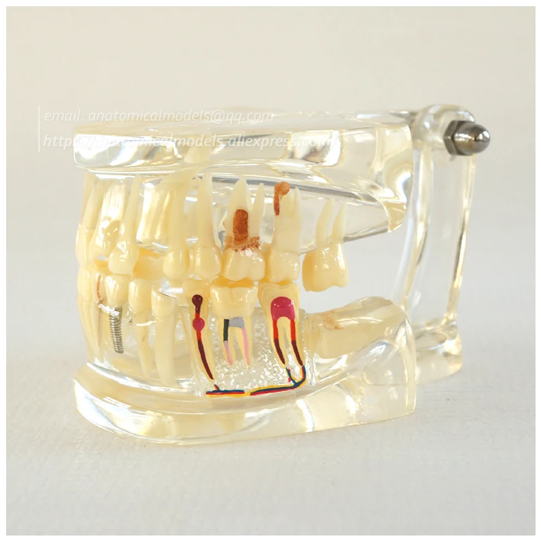 13066 Half Pathology Model 2 