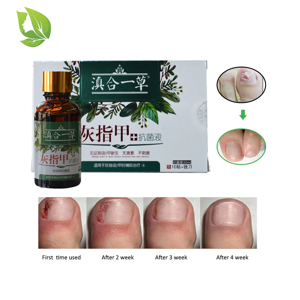 1 pack Nail Repair Essence Serum Fungal Nail Care Treat Remove