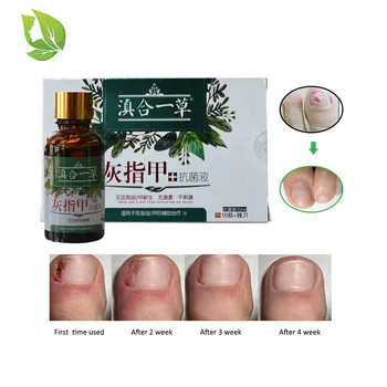 

1 pack Nail Repair Essence Serum Fungal Nail Care Treat Remove Onychomycosis Hands and Feet Care of Toe Nail Nourishing Brighte