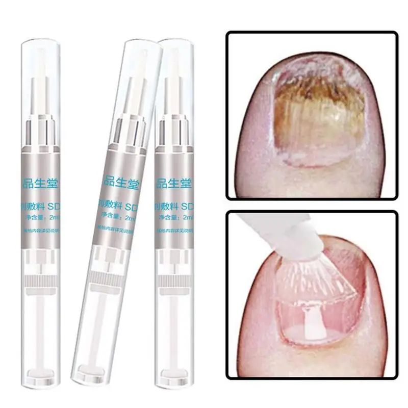 

2ml Anti Fungal Treatment Nail Pen Onychomycosis Paronychia Infection Herbal Toe Finger Nails Health Beauty Accessories