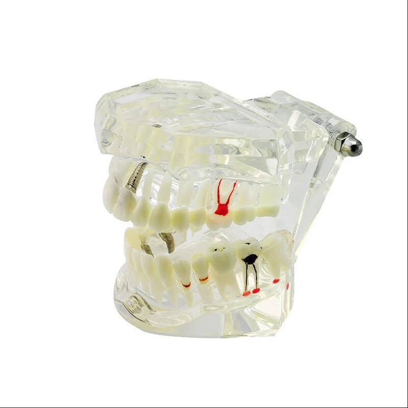 

Oral Clinic Transparent Adult Dental Restoration Bridge Tooth Model Removable Dentist Teaching Dental Implant Study