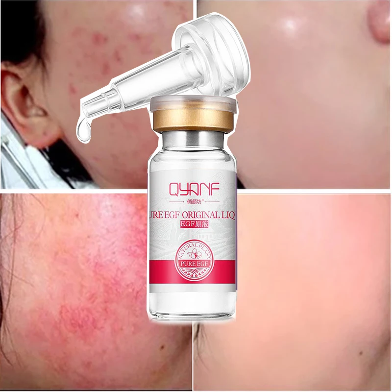5pcs EGF Essence Serum Remove Acne Scars Fade Melanin Anti Allergy