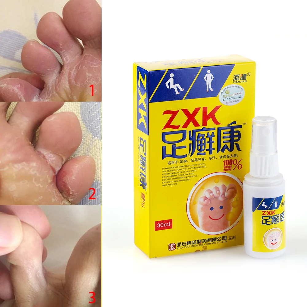 1pc Effective Herb Anti Fungal Infection Beriberi Tinea Pedis Treatment