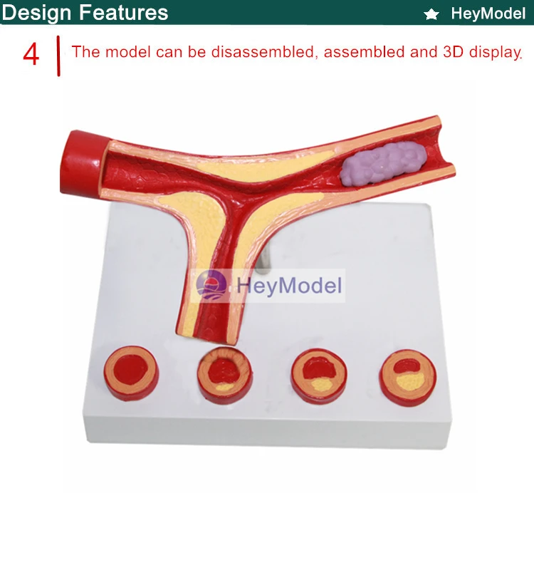 Heymodel человека сосудистых атеросклероза модель