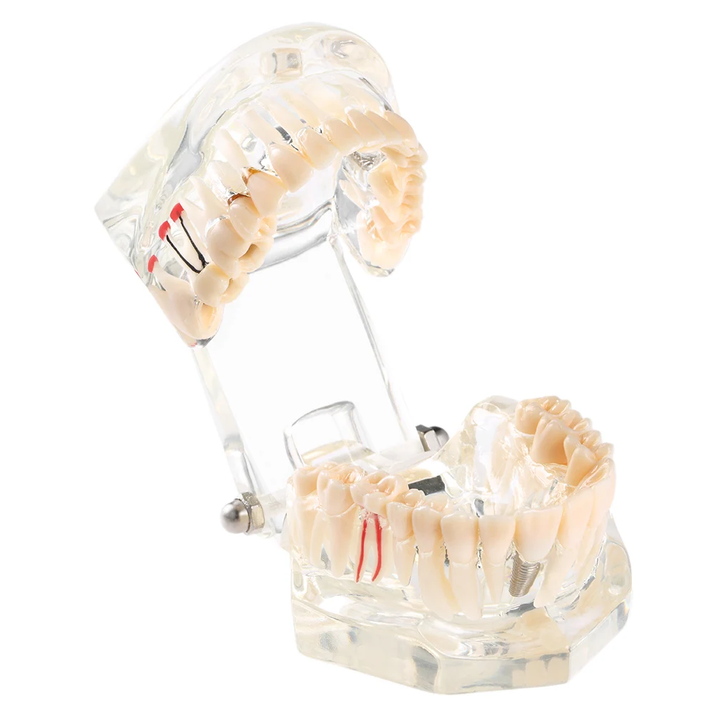 Прозрачная модель зубов нижняя челюсть Модель Стоматологическая имплантация инфекция съемные Обучающие инструменты для зубов стоматологическая медицинская наука