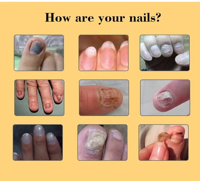 Nail efero repair treatment gel essence serum fungus nourish toe cuticle care efero Nail Repair Essence Serum Nail Treatment Repair Fungus Nail Toe