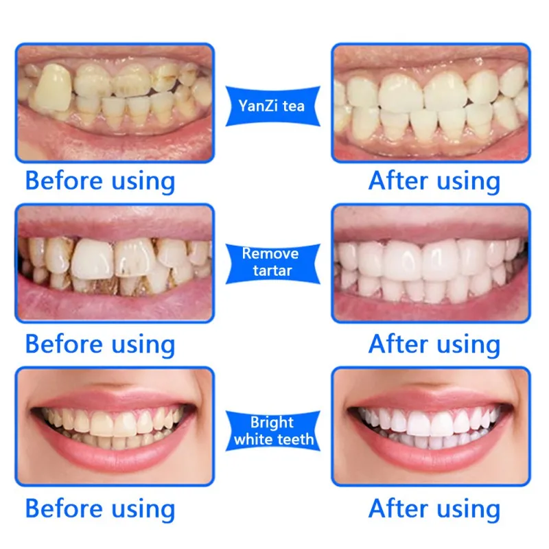 Зубы ярче гигиена полости рта чистящие средства Красители для удаления Gentle натуральные растительные порошок для отбеливания зубов