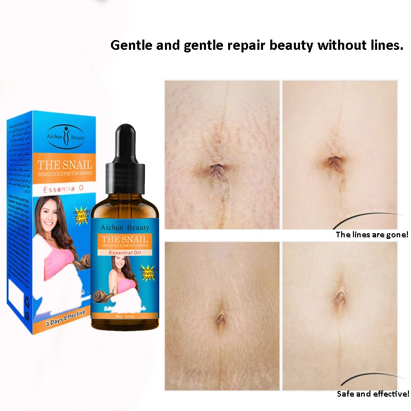 

Remove Pregnancy Scars Acne Essential Oil Stretch Marks Treatment Maternity Repair Anti-Aging Anti Winkles Firming Body Cream