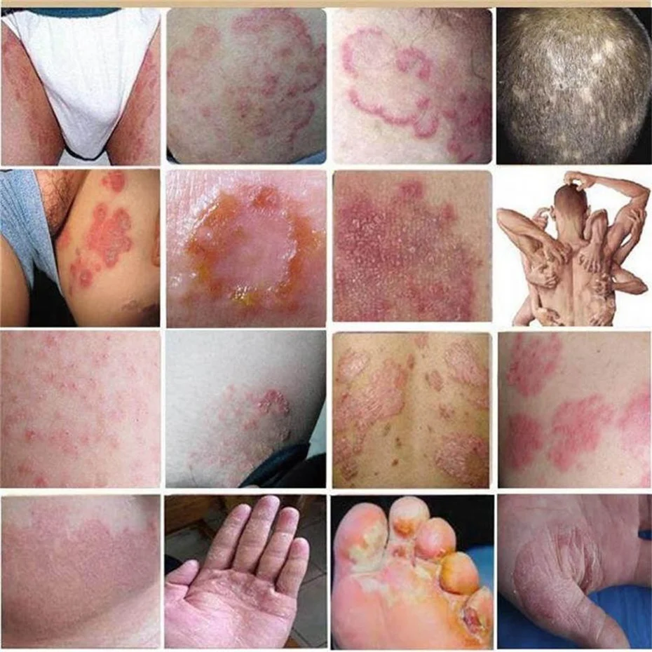 3 шт. псориаз, дерматит, Eczema Pruritus крем для проблем с кожей+ 3 шт. yandaifu крем для ухода за кожей без розничной упаковки