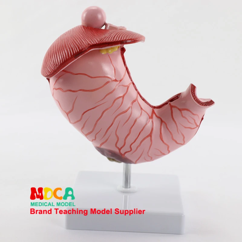 Model Medicine Teaching MCW011 for Human AT Pathological Gastric Anatomy and Demonstration of Gastric Diseases