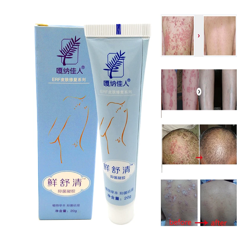 

New China Herbal Bacteriostatic Gel Psoriasis Creams Body Psoriasis Dermatitis And Eczema Pruritus Psoriasis Skin Problems