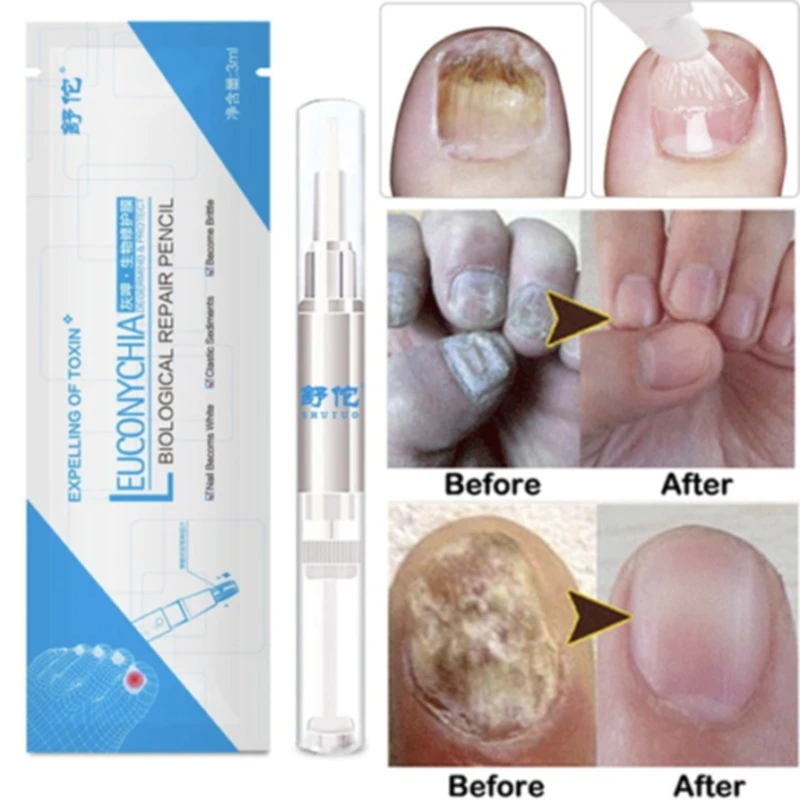 

1PC Advanced Fungal Nail Natural Repair Magic Pen Remove onychomycosis