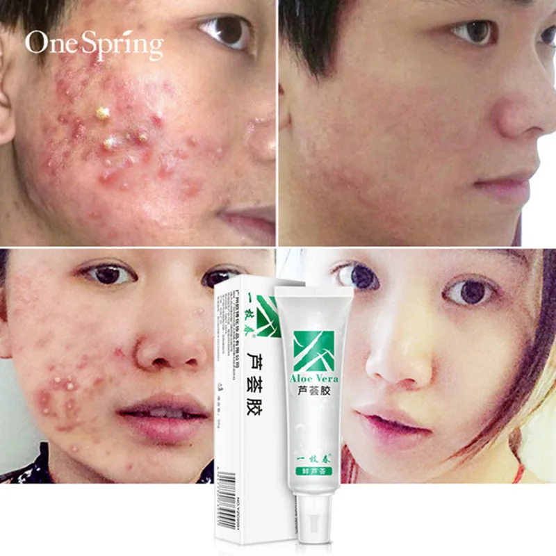 

Aloe Vera Gel Face Cream Anti Acne Anti-sensitive Oil-control Repair After Sun Tanning Moisturizing Relieving Itchy Skin Care
