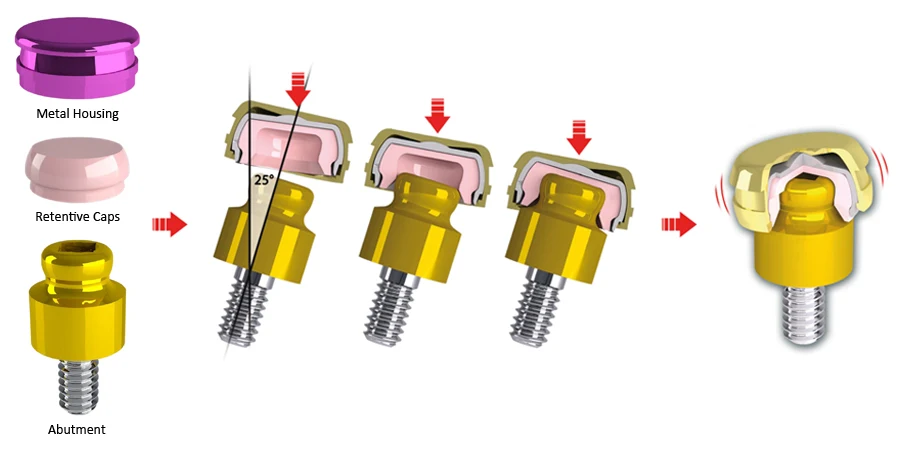 Equator+abutment