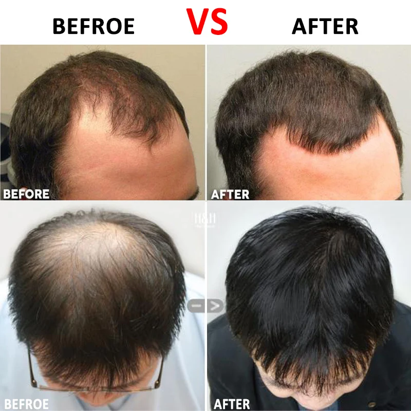 

Hair Regrowth Micro-needling Roller Beard Growth Product Anti Hair Loss