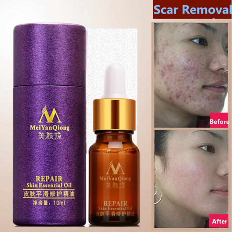 

Scar Repair Skin Essential Oil Lavender Essence Skin Care Natural Pure Remove Ance Burn Strentch Marks Scar Removal Treatment