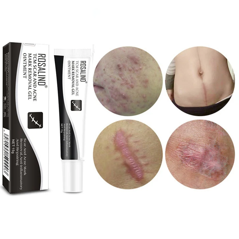 Acne Scar Removal Cream Skin Repair Face Spots Treatment Blackhead Whitening Stretch Marks | Красота и здоровье
