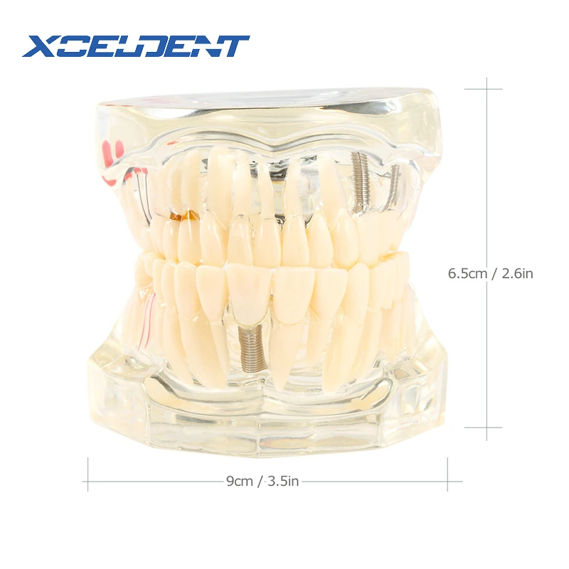 1 шт. зубной имплантат, зубная модель с реставрационным мостом, зубной Стоматолог для медицинской медицины, стоматологический тест на лечение